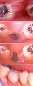 Implante Dental Molar
